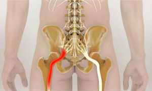 Как избавиться от болей в нижней части спины