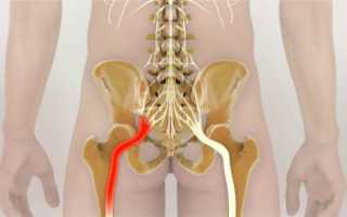 Как избавиться от болей в нижней части спины