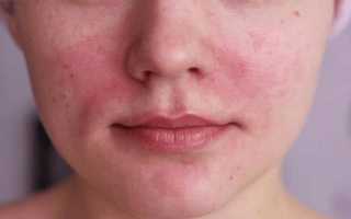 Нервничаю лицо краснеет голова болит