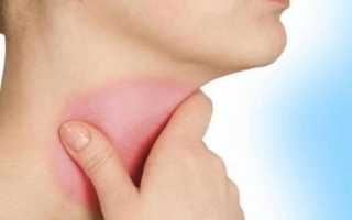 Болит горло и голова температуры нет что это может быть