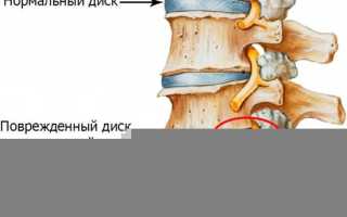 Почему болит спина в пояснице лежа