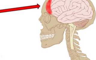Болит лобовая часть головы что это