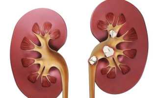 Болит спина при мочекаменной