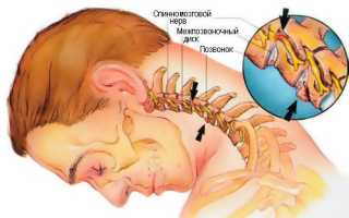 Болит шея с правой стороны сзади и в спину