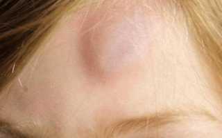 От шишек болит голова