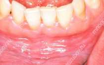 Вздулась десна болит голова