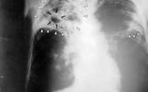 Мокрота с кровью и болит спина