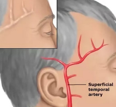 От чего может болеть правый весок головы