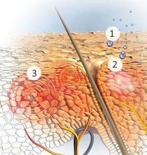 1. Влага теряется, вызывая сухость. 2. Микровоспалительные процессы вызывают дальнейшее раздражение. 3. Кожа головы начинает чесаться