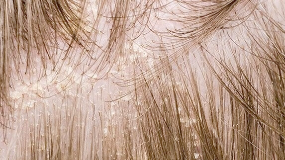 Перхоть при себорее