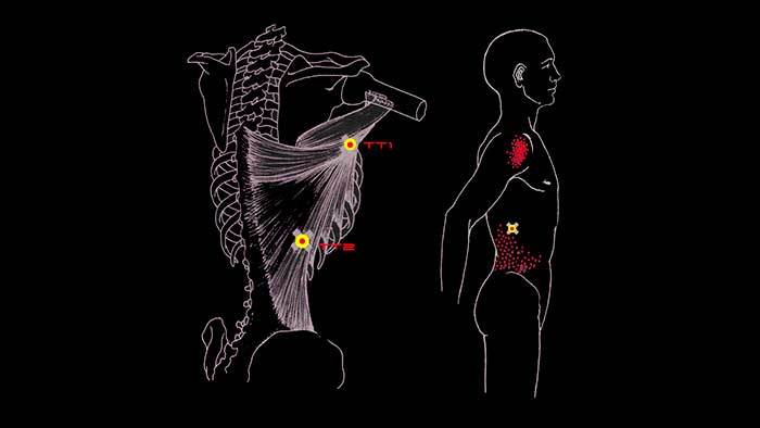 ÁÎËÈÒ ÑÏÈÍÀ Â ÎÁËÀÑÒÈ ËÎÏÀÒÊÈ: øèðî÷àéøàÿ ìûøöà ñïèíû Çäîðîâüå, Ìåäèöèíà, Àíàòîìèÿ, Ñïîðò, Ôèòíåñ, Âèäåî, Ãèôêà, Äëèííîïîñò
