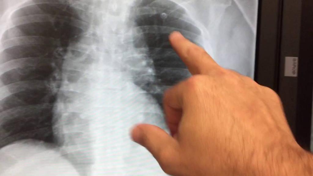 как лечить ушиб ребра в домашних условиях