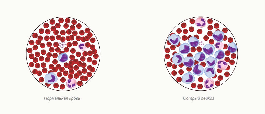 Рак крови: первые симптомы, диагностика, лечение и выживаемость