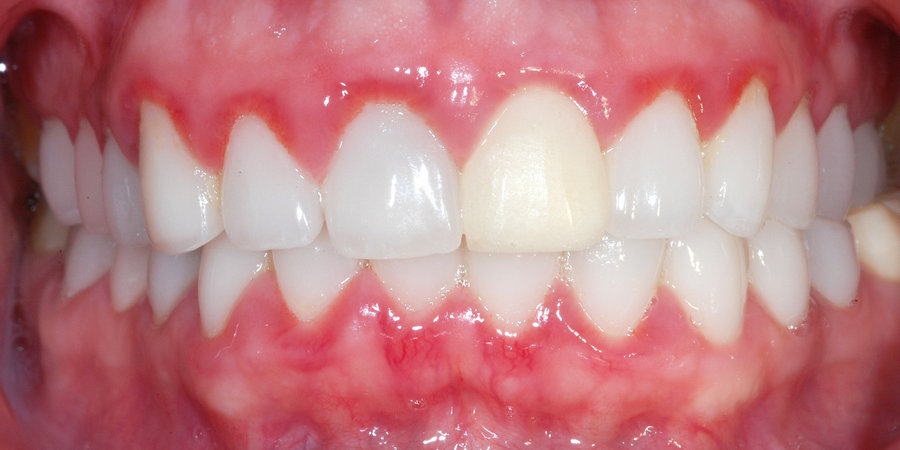 Заболевание гингивитом