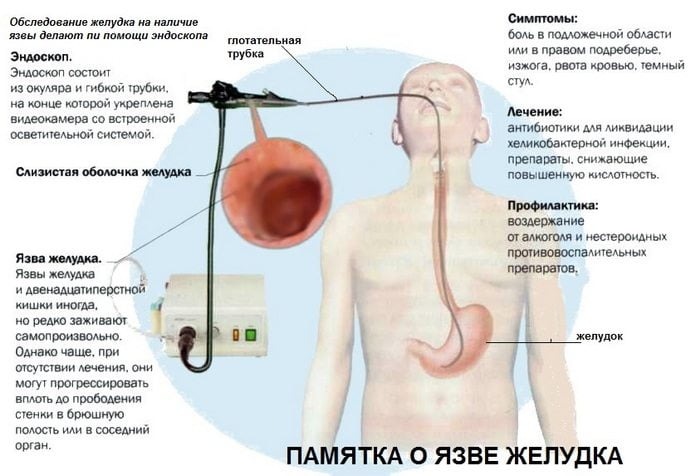 Памятка о язве желудка