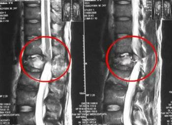При наклоне головы болит в районе лопатки