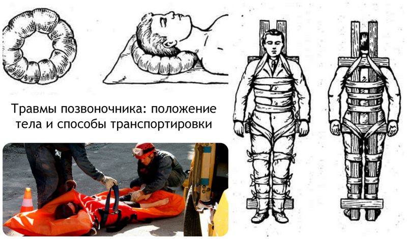 Иммобилизация при ушибе позвоночника