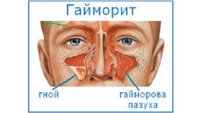 Слабость во всем теле и болит голова что может быть