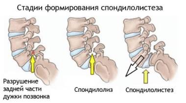Болит спина посередине позвоночника когда сплю