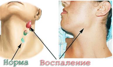 Болит спина есть температура
