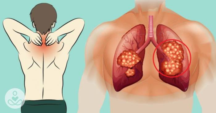 Болит спина в области лопаток врач