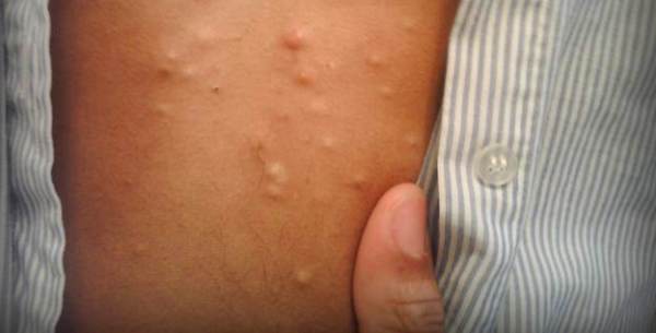 Узелки на коже