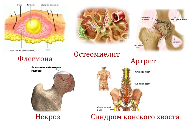 Заболевания — причины боли в ягодицах Заболевания — причины боли в ягодицах