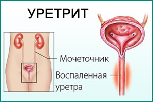 Воспаление уретры