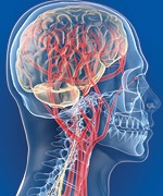 Микроинсульт