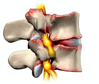 Болит спина посередине позвоночника когда сплю