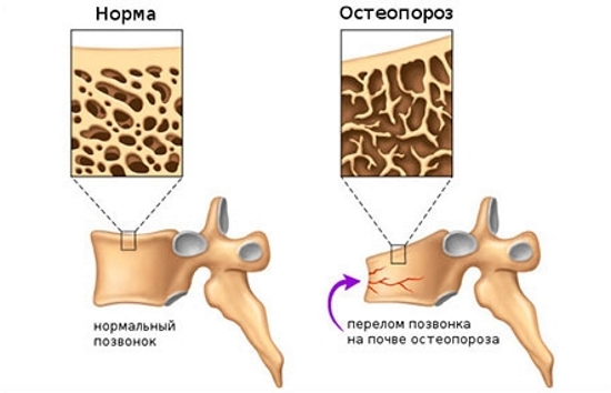 Перелом позвонка на фоне остеопороза