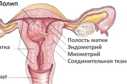 Полип матки - причина задержки месячныхi