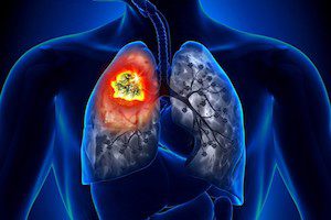 Рак легких