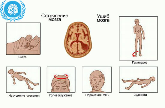 после сотрясения мозга болит голова что принимать