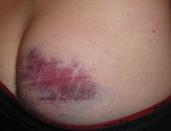 Синяк после укола в ягодицу