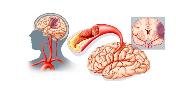 Инсульт, как одно из последствий смешивания Терафлю и спиртного
