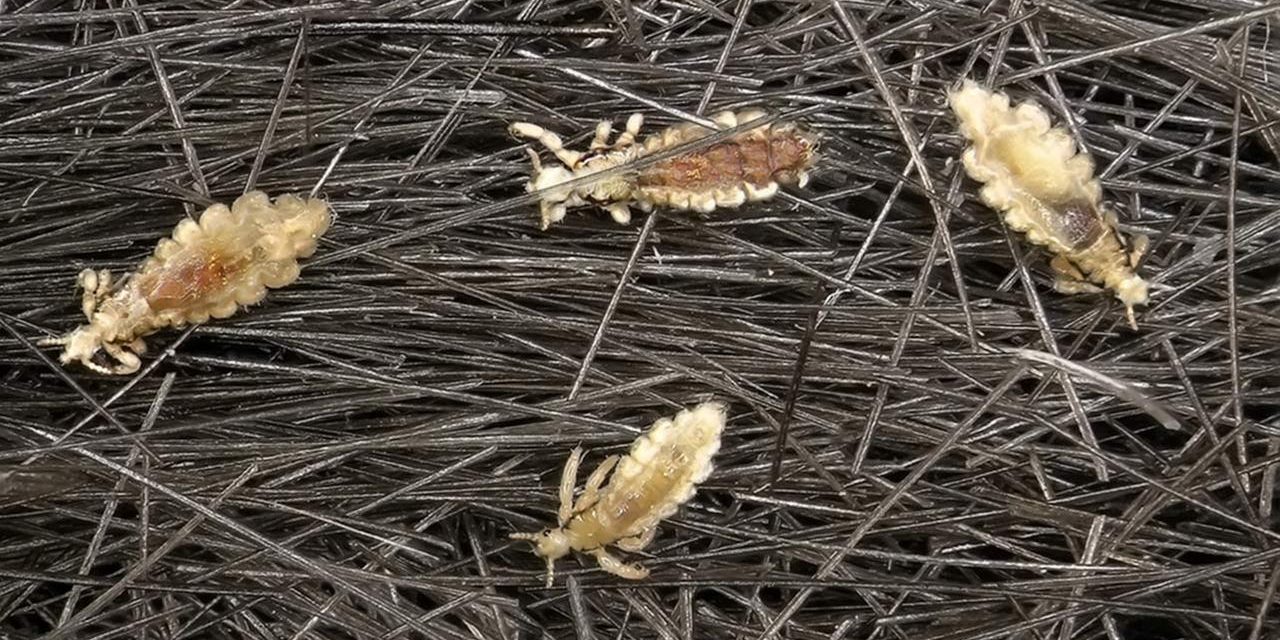 Чешется голова из-за вшей