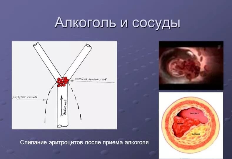 Воздействие алкоголя на сосуды