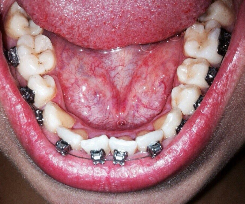 Использование брекет-системы